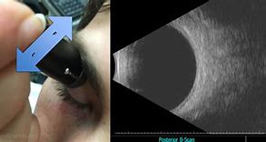 Image result for Ophthalmic Ultrasound
