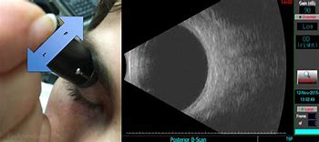 Image result for A Scan Ultrasound Eye