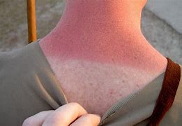 Image result for Skin Cancer From SunBurn