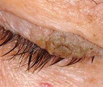 Image result for Flat Warts On Eyelids