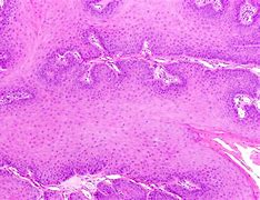 Image result for What Causes Squamous Papilloma