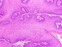 Image result for Papilloma of Skin