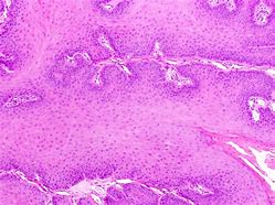 Image result for What Causes Squamous Papilloma