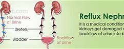 Image result for Reflux Nephropathy