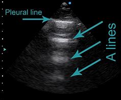 Image result for Anechoic Lines in Ultrasound