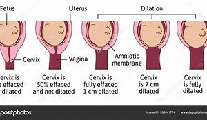 Image result for 10 Cm Cervix Dilation