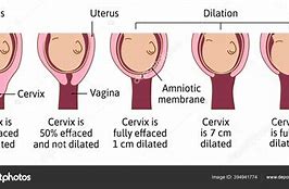 Image result for 4 Cm Dilated Cervix