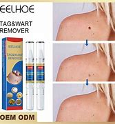 Image result for Mole Removers Over Counter