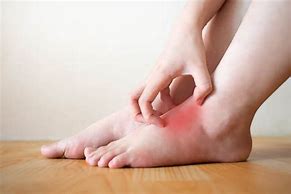 Image result for Red Itchy Spots On Foot
