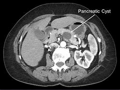 Image result for Pancreas Tumor MRI