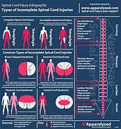 Image result for Spinal Cord Injuries