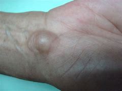 Image result for Lump On Wrist Area