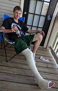 Image result for Broken Leg Hospital