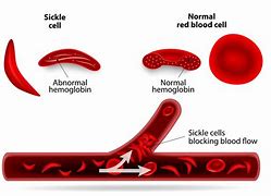 Image result for Sickle Cell Anemia Eyes
