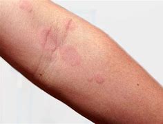 Image result for Eczema Bumps On Arms