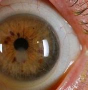 Image result for Lasik Corneal Scar