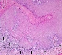 Image result for Verrucous Squamous Cell Carcinoma