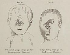 Image result for Human Forms of Cyclopia