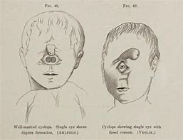 Image result for Cyclopia Baby