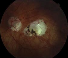 Image result for Pathological Myopia