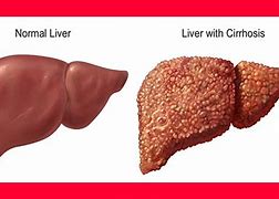 Image result for liver cirrhosis
