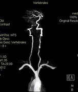 Image result for Vertebral Artery Insufficiency