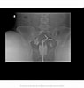 Image result for Uterus Didelphys. Size: 95 x 100. Source: radiopaedia.org