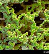 Image result for Infected Molluscum