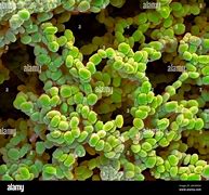 Image result for Molluscum Infection