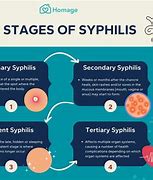 Image result for Late-Stage Syphilis