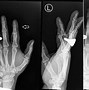 Image result for MIP Hand