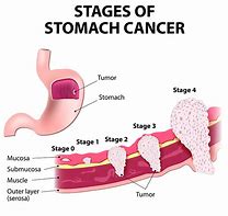 Image result for Stomach Cancer Tumor Size