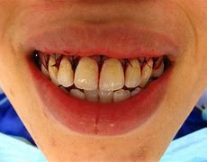 Image result for Covered in Teeth