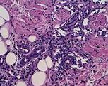 Image result for Kaposi Sarcoma