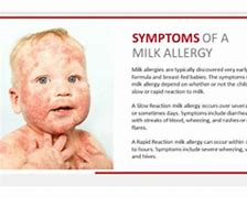 Image result for Milk Allergy Skin Reaction