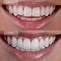 Image result for Invisalign Images