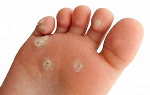 Image result for Human Papilloma Virus in Foot