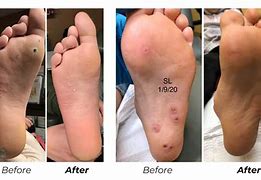 Image result for Plantar Wart Cut Out