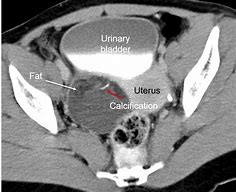 Image result for Ovary Dermoid Cyst CT Scan