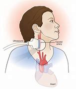 Image result for Carotid Ultrasound