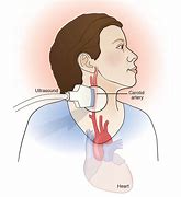 Image result for Carotid Doppler Ultrasound