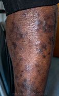 Image result for Kaposi Sarcoma Black Skin