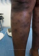 Image result for Kaposi Sarcoma Black Skin