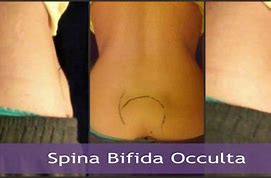 Image result for Skin Stigmata of Spina Bifida Occulta
