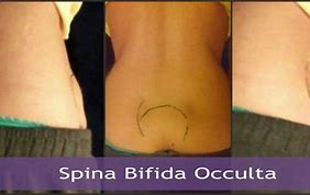 Image result for Spina Bifida Occulta in Newborn