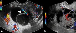 Image result for Ovarian Cancer On Ultrasound