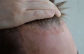 Image result for Eczema in Hair