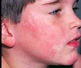 Image result for 5th Disease