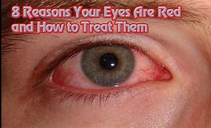 Image result for Red Blurry Eyes