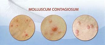 Image result for Molluscum Outbreak